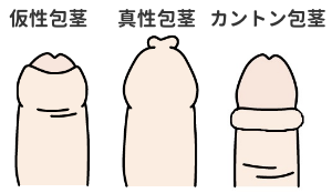 包茎の種類(仮性包茎・真性包茎・カントン包茎)の図解イラスト